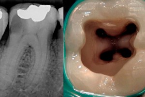 endodoncia-chile